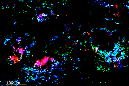 breast cancer metastases